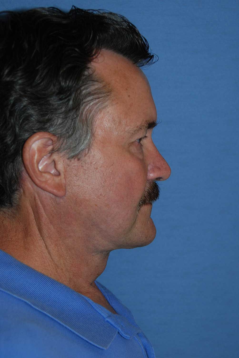 60's Caucasian Male with Severe Neck Sagging & Laxity, Facial Jowling & Platysmal Muscle Banding After Face Lift NeckLift Lateral View 60's Caucasian Male with Severe Neck Sagging & Laxity, Facial Jowling & Platysmal Muscle Banding After Face Lift NeckLift Lateral View