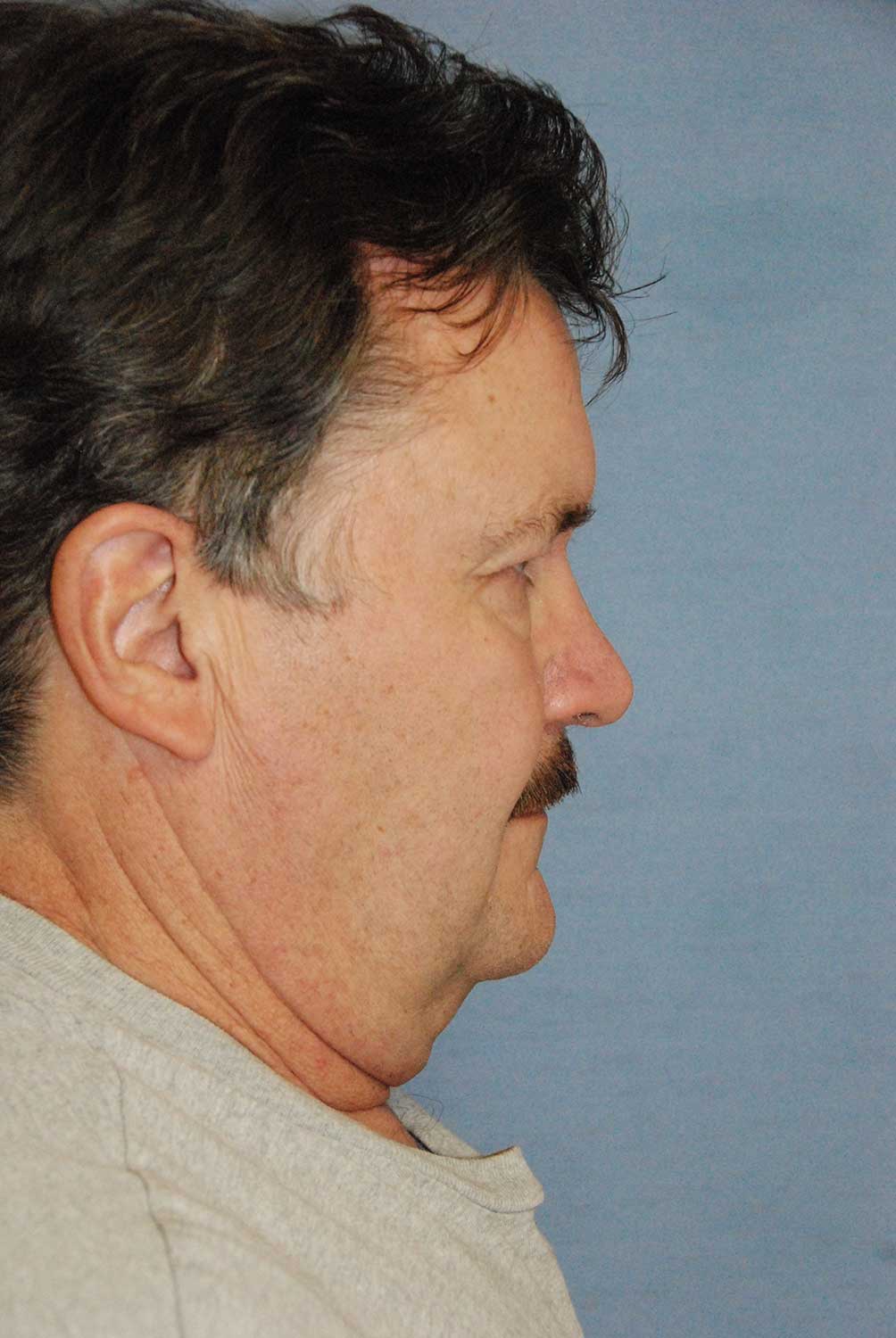 60's Caucasian Male with Severe Neck Sagging & Laxity, Facial Jowling & Platysmal Muscle Banding Before Face Lift NeckLift Lateral View 60's Caucasian Male with Severe Neck Sagging & Laxity, Facial Jowling & Platysmal Muscle Banding Before Face Lift NeckLift Lateral View