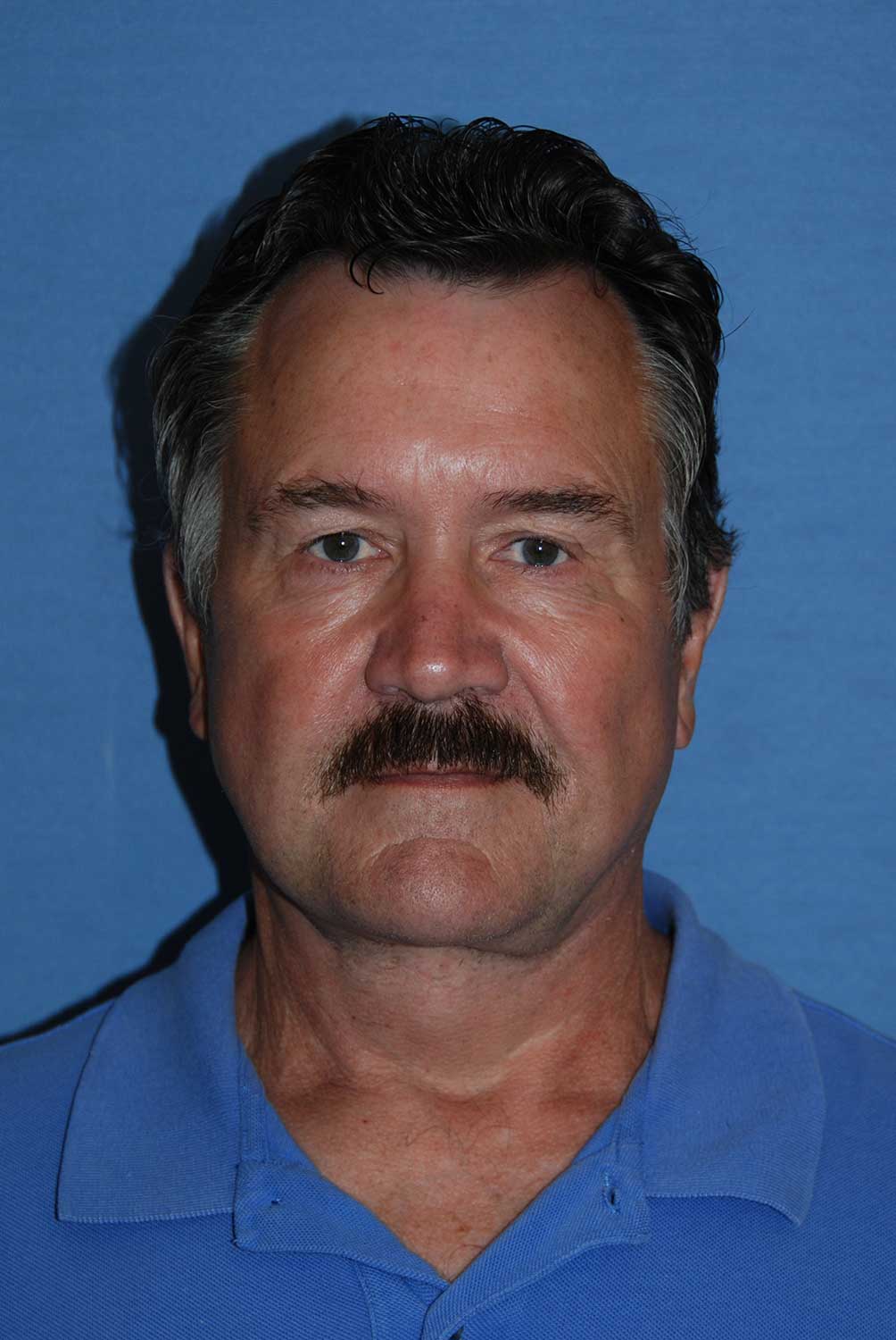 60's Caucasian Male with Double Chin, Turkey Neck, Severe Neck Sagging & Laxity, Facial Jowling & Platysmal Muscle Banding After Face Neck Lift Front View 60's Caucasian Male with Double Chin, Turkey Neck, Severe Neck Sagging & Laxity, Facial Jowling & Platysmal Muscle Banding After Face Neck Lift Front View