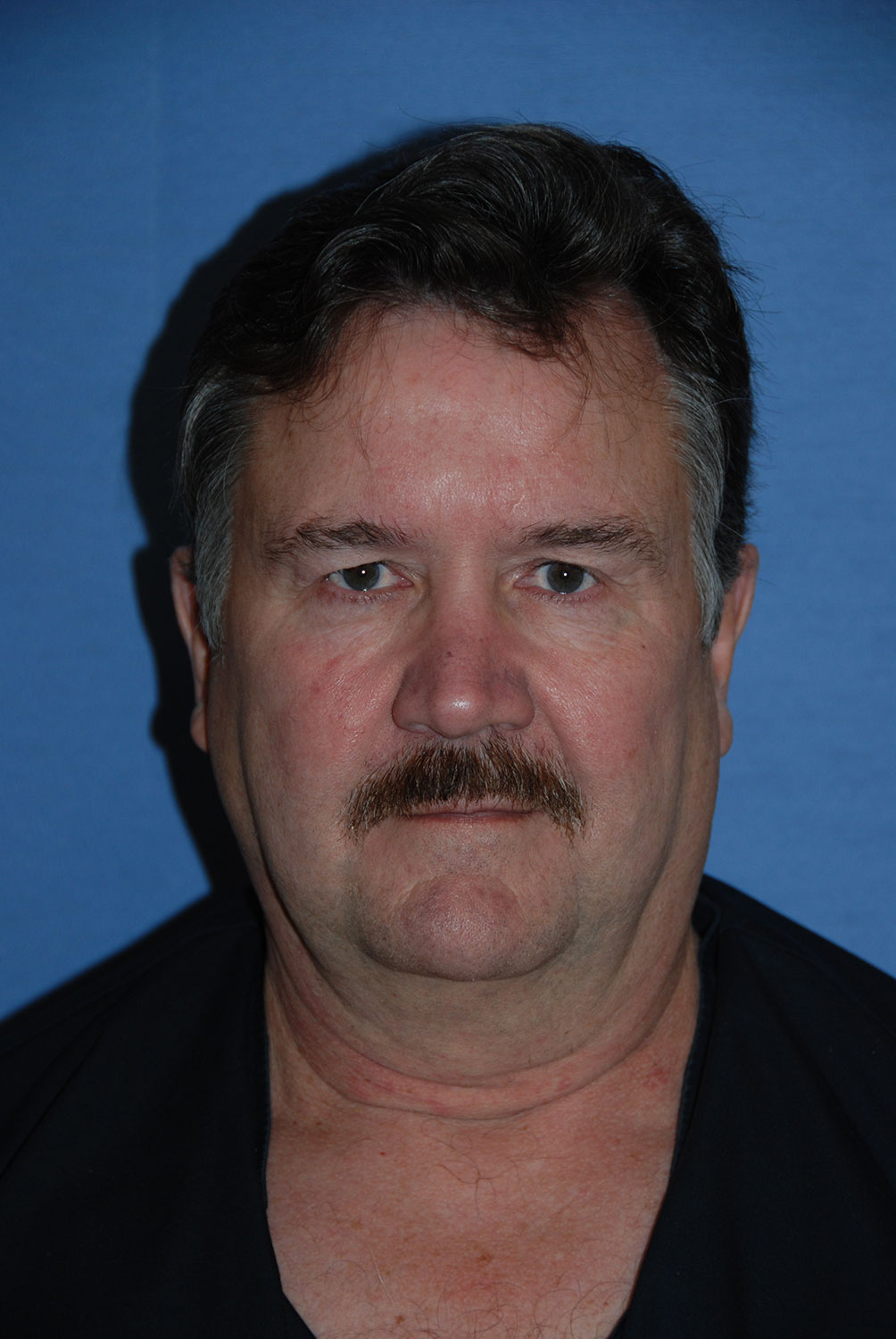 60's Caucasian Male with Double Chin, Turkey Neck, Severe Neck Sagging & Laxity, Facial Jowling & Platysmal Muscle Banding Before Face Neck Lift Front View 60's Caucasian Male with Double Chin, Turkey Neck, Severe Neck Sagging & Laxity, Facial Jowling & Platysmal Muscle Banding Before Face Neck Lift Front View