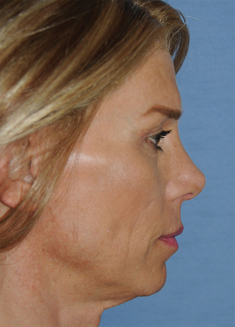 After Transgender Feminization Rhinoplasty Procedure Side Profile