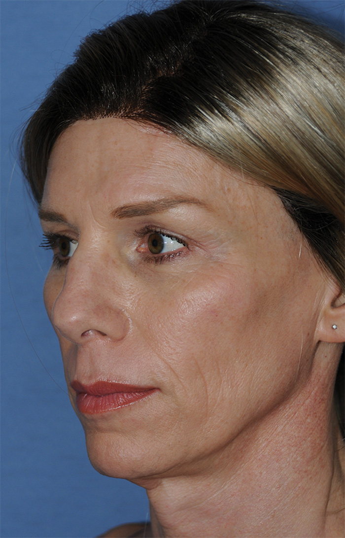 Before Transgender Feminization Rhinoplasty Procedure  Oblique View