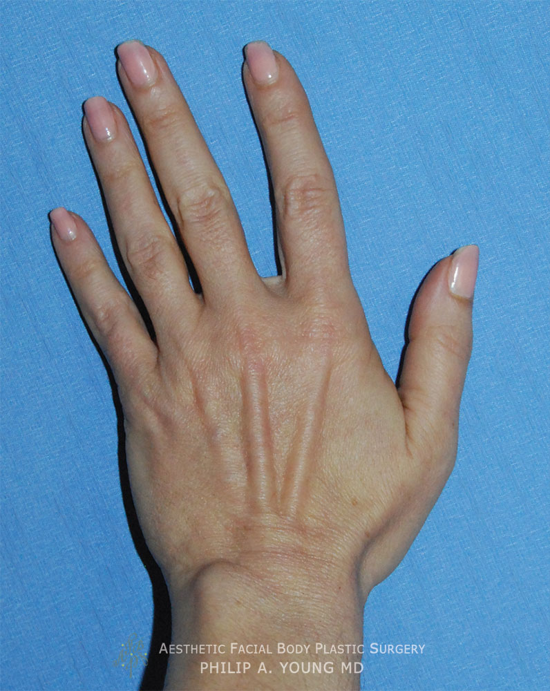 Fat Grafting to the Hands and Fingers Before Image Fat Grafting to the Hands and Fingers Before Image