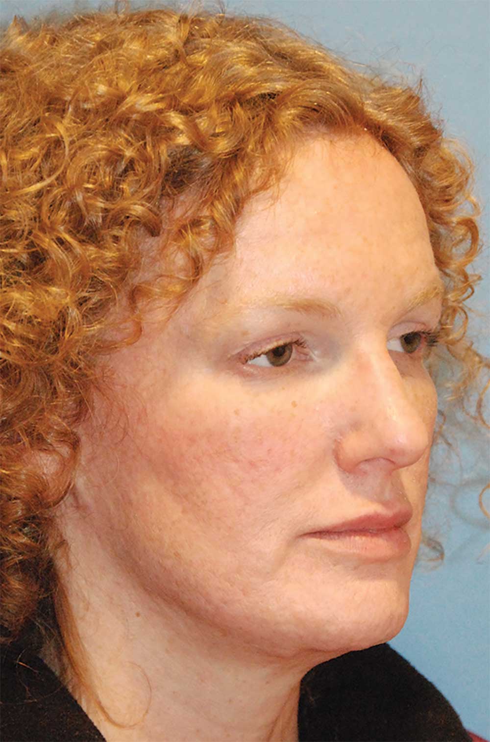 Face Filler Injections to The Upper, Lower Eyelid After Face Filler Injections to The Upper, Lower Eyelid After