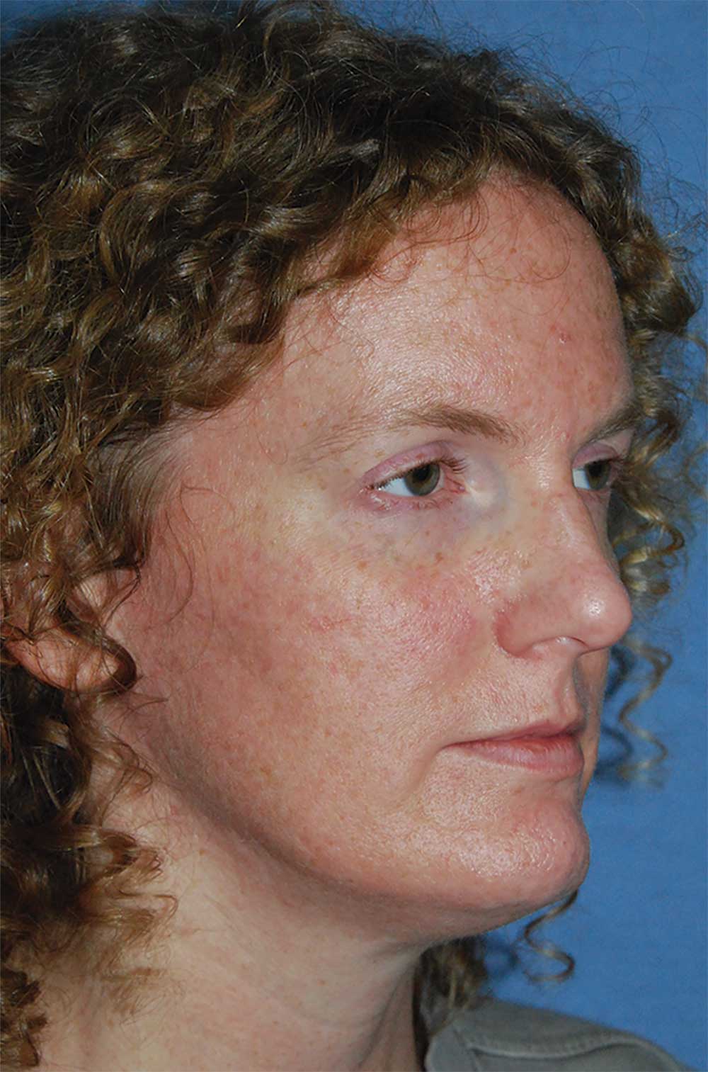Face Filler Injections to The Upper, Lower Eyelid Before Face Filler Injections to The Upper, Lower Eyelid Before