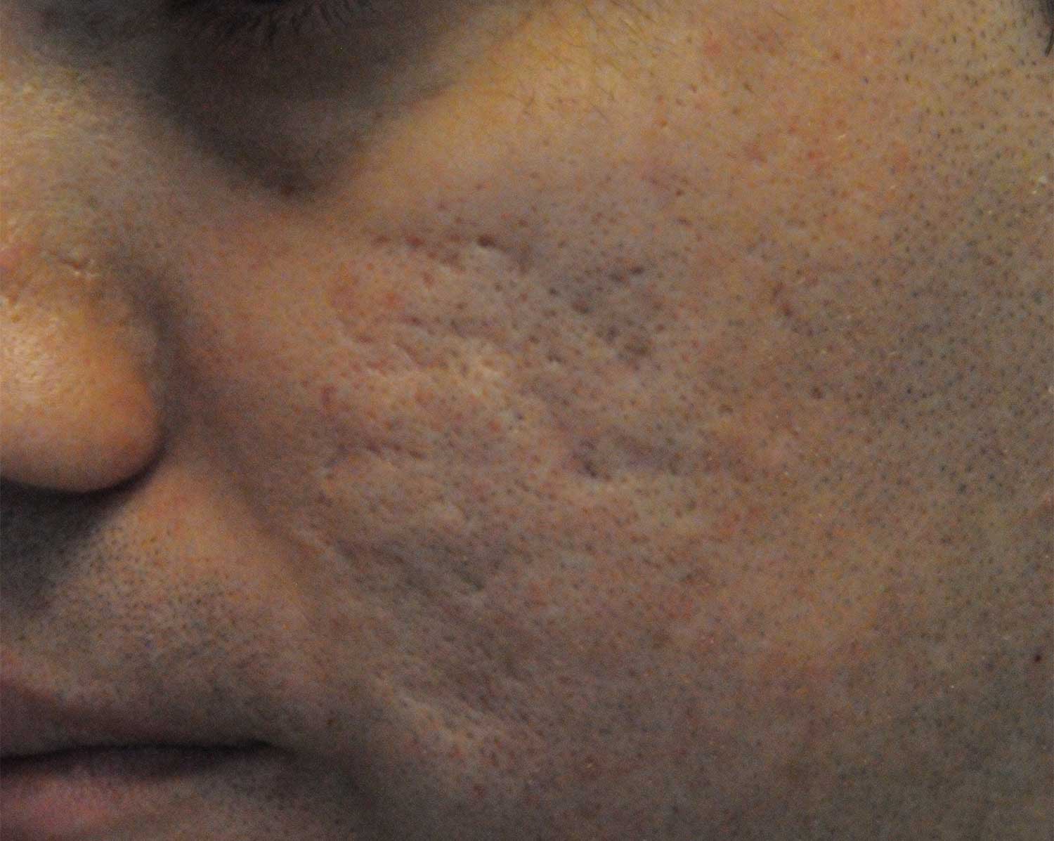 Acne Scar Treatment Before & After Photo