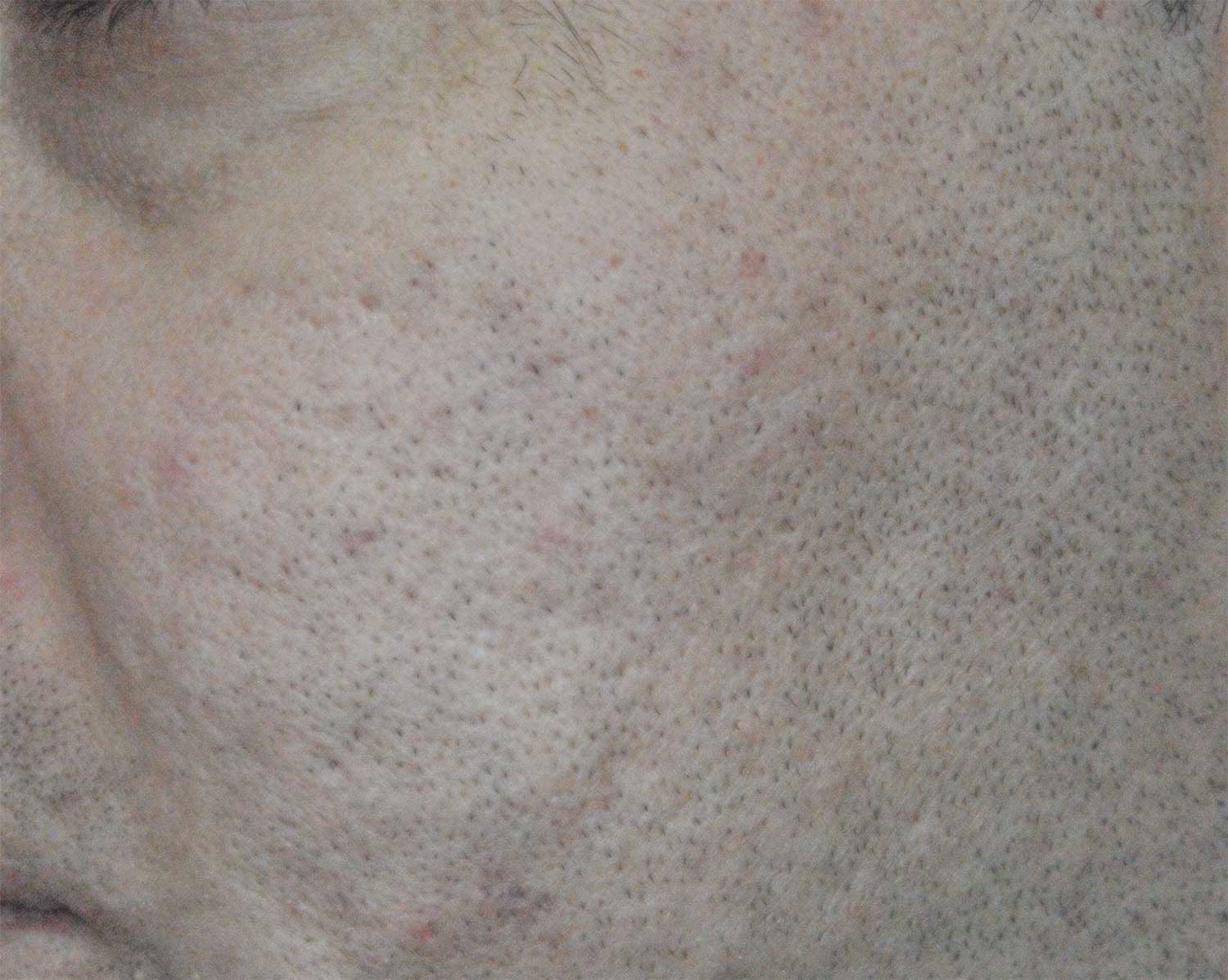 Acne Scar Treatment Before & After Photo