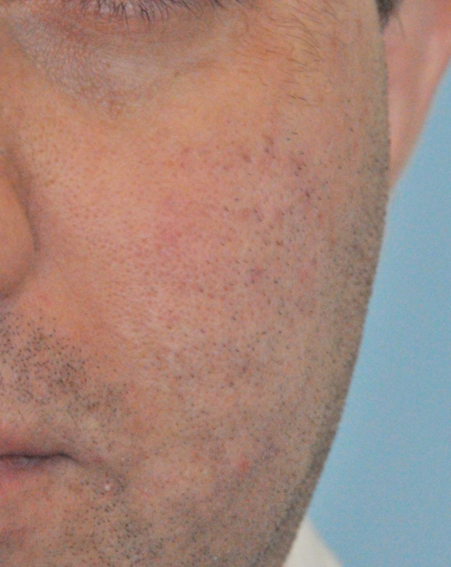 Acne Scar Treatment Before & After Photo