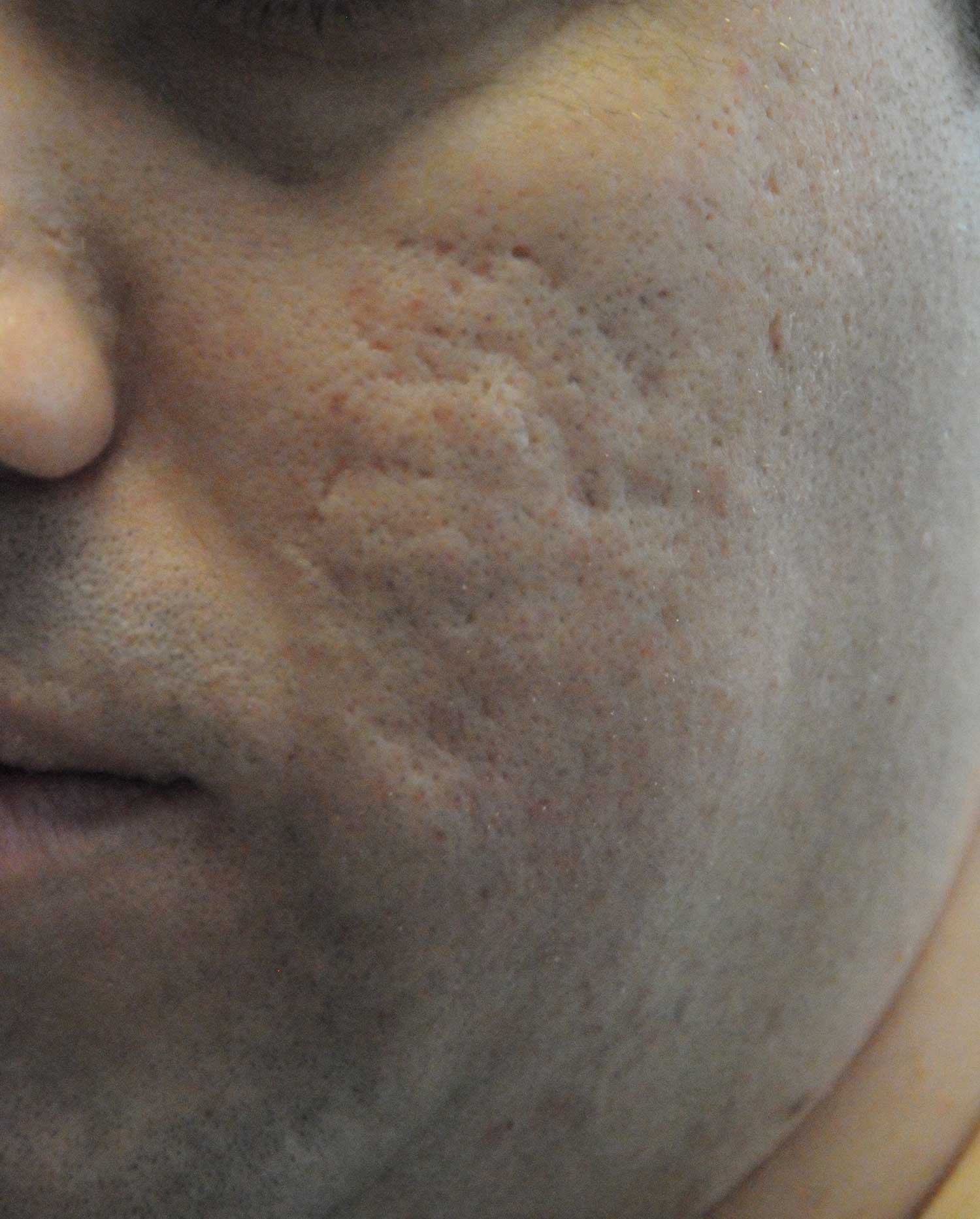 Acne Scar Treatment Before & After Photo