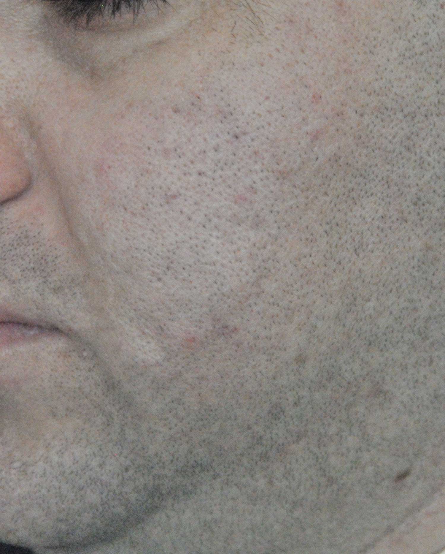 Acne Scar Treatment Before & After Photo