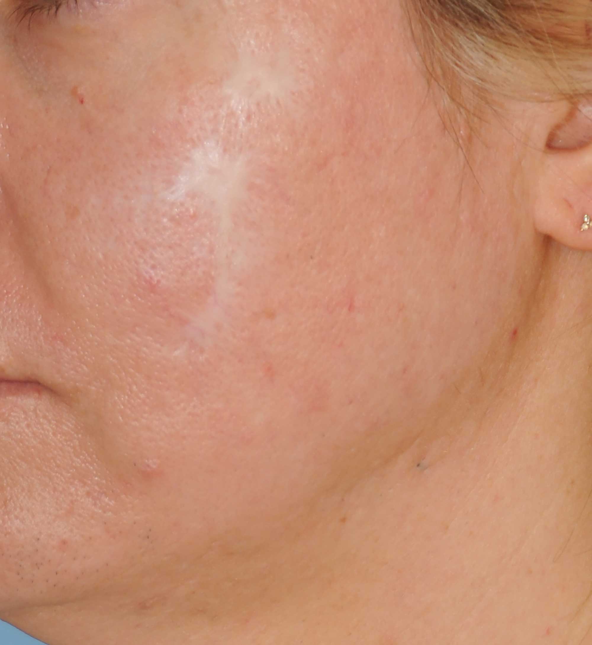 Acne Scar Treatment Before & After Photo