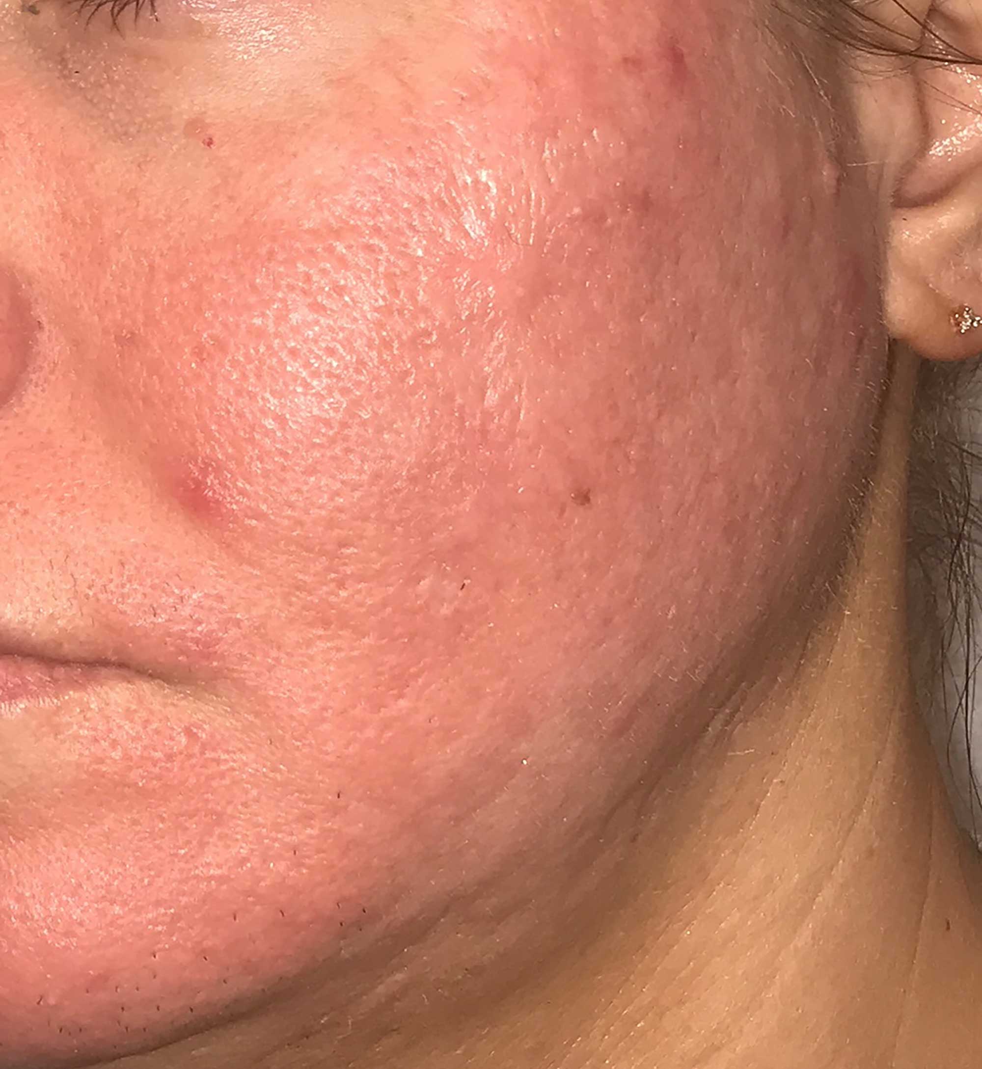 Acne Scar Treatment Before & After Photo