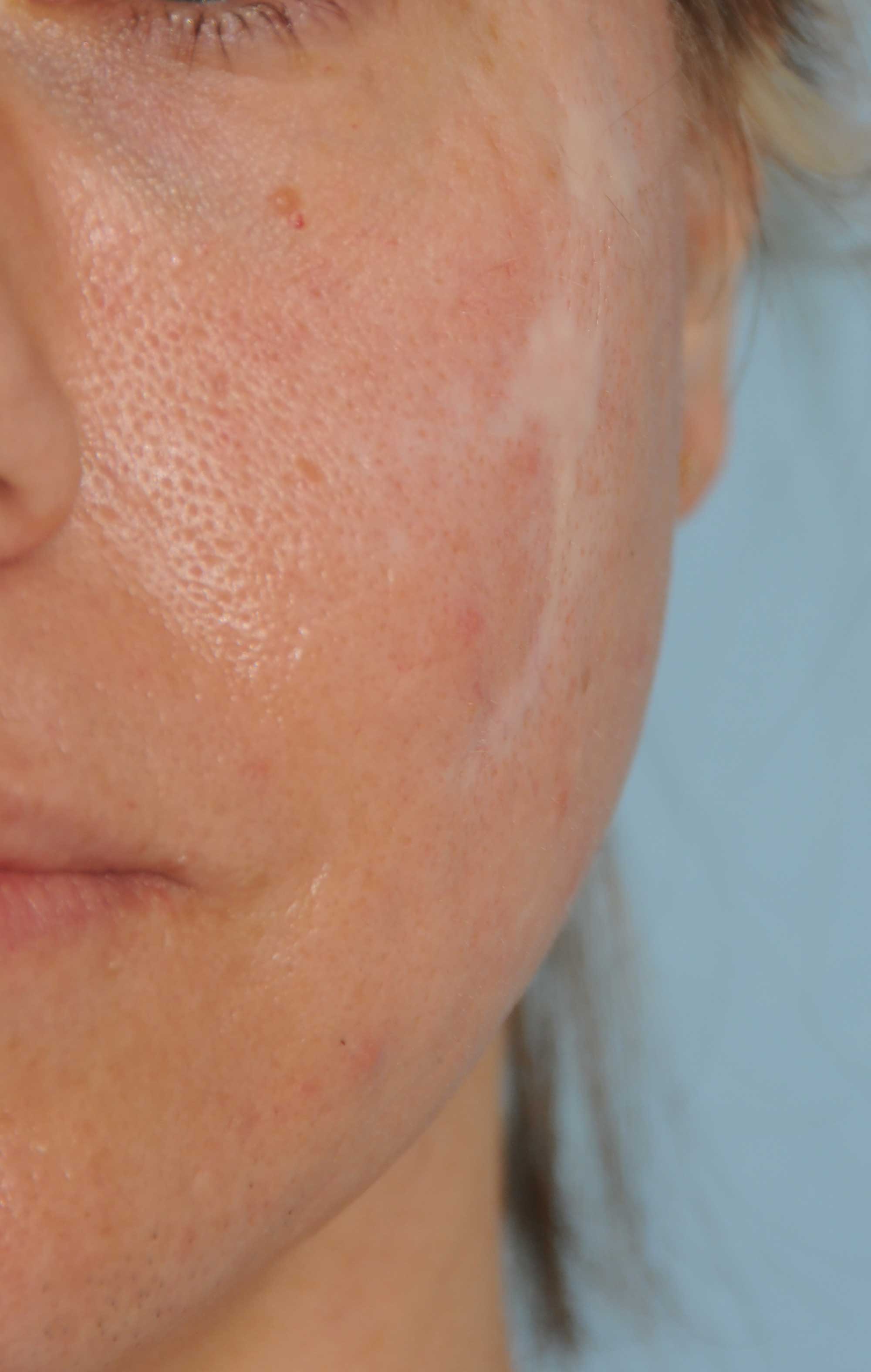 Acne Scar Treatment Before & After Photo