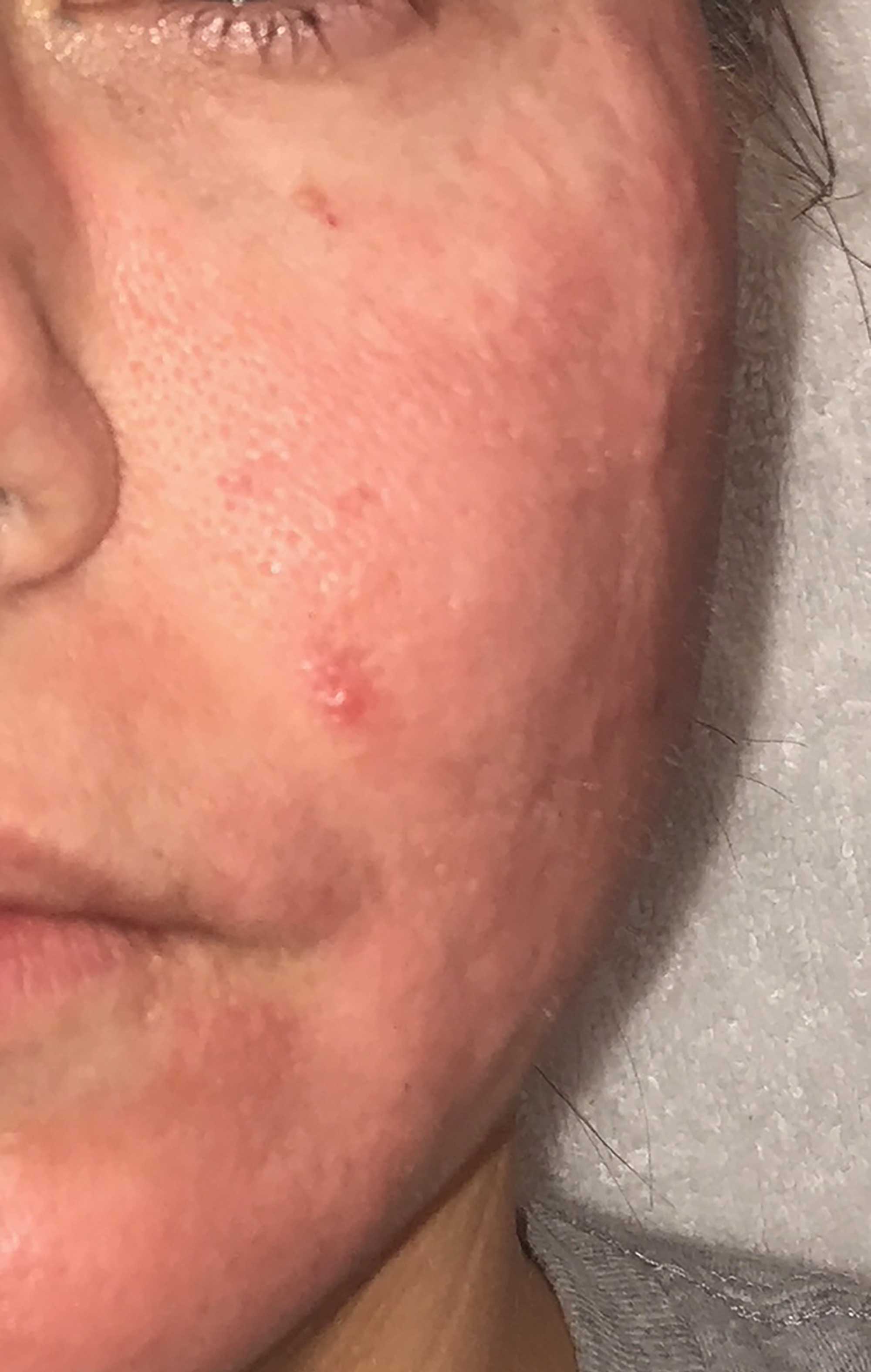 Acne Scar Treatment Before & After Photo