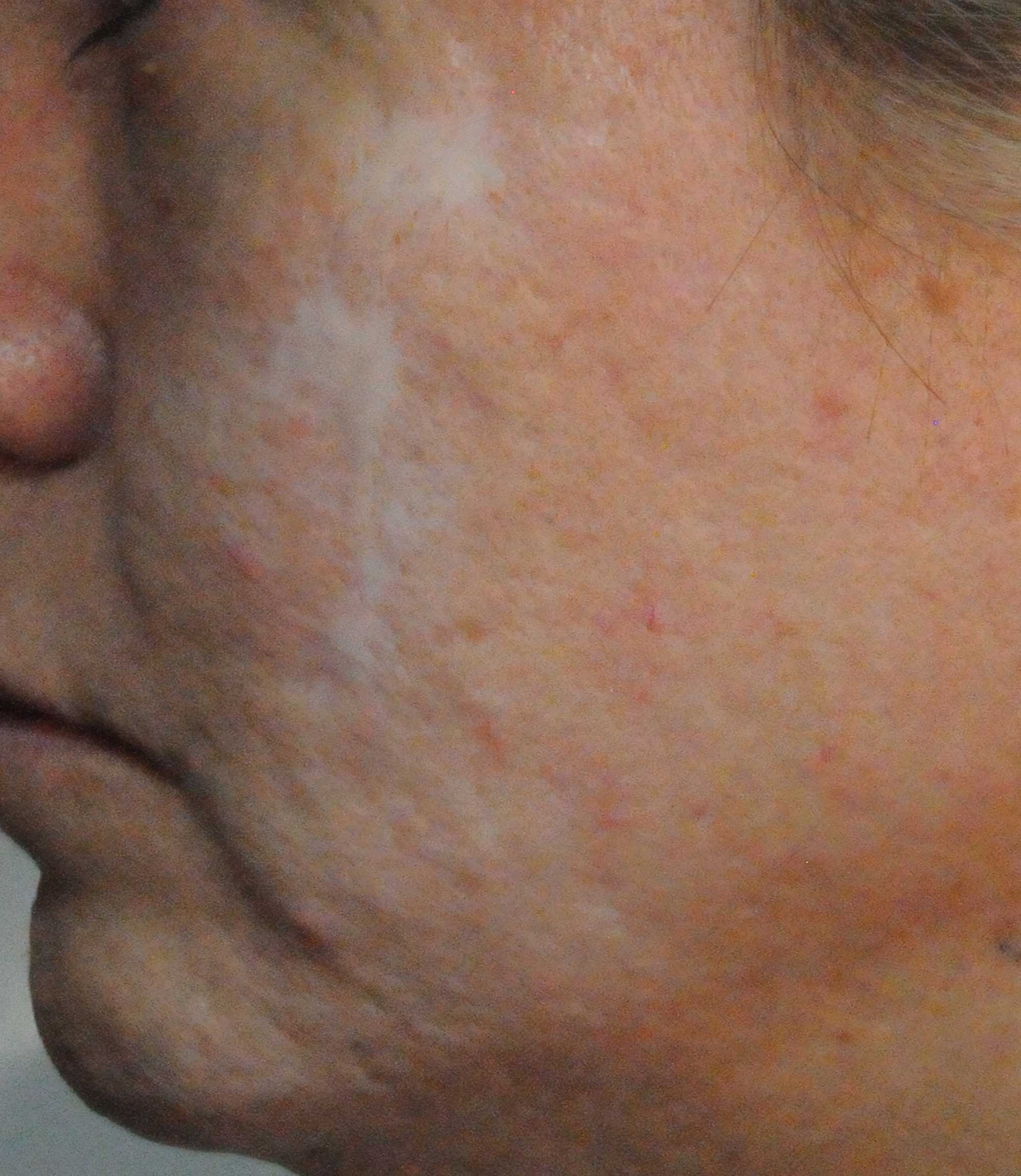 Acne Scar Treatment Before & After Photo