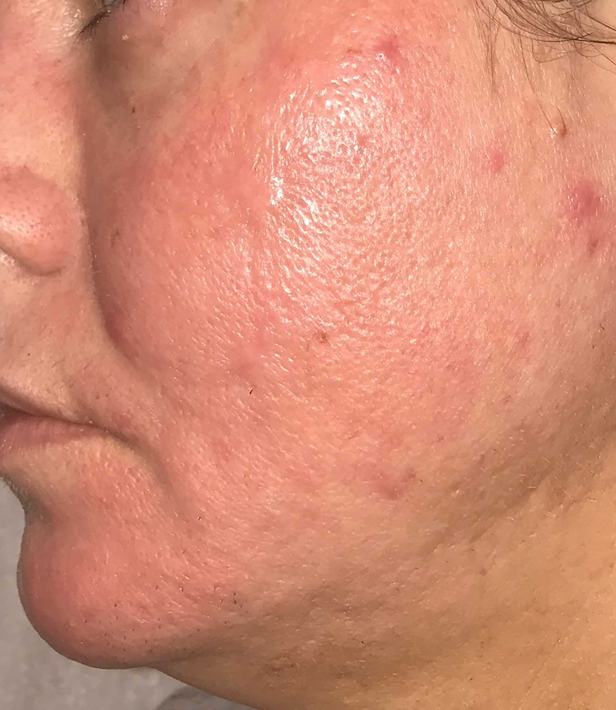 Acne Scar Treatment Before & After Photo