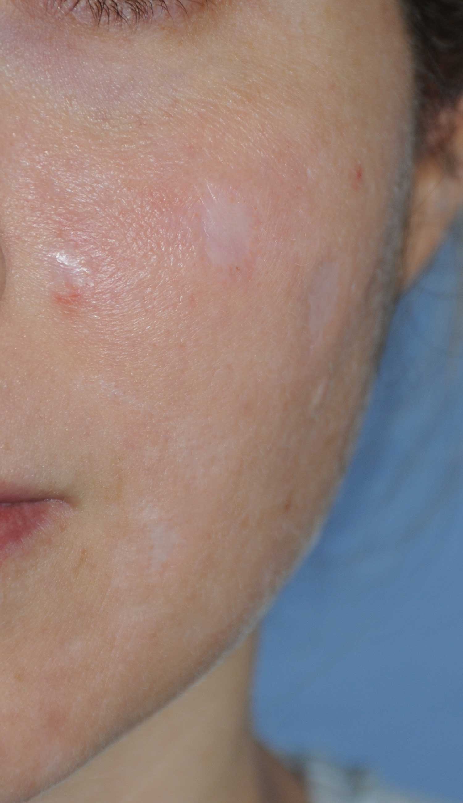 Acne Scar Treatment Before & After Photo