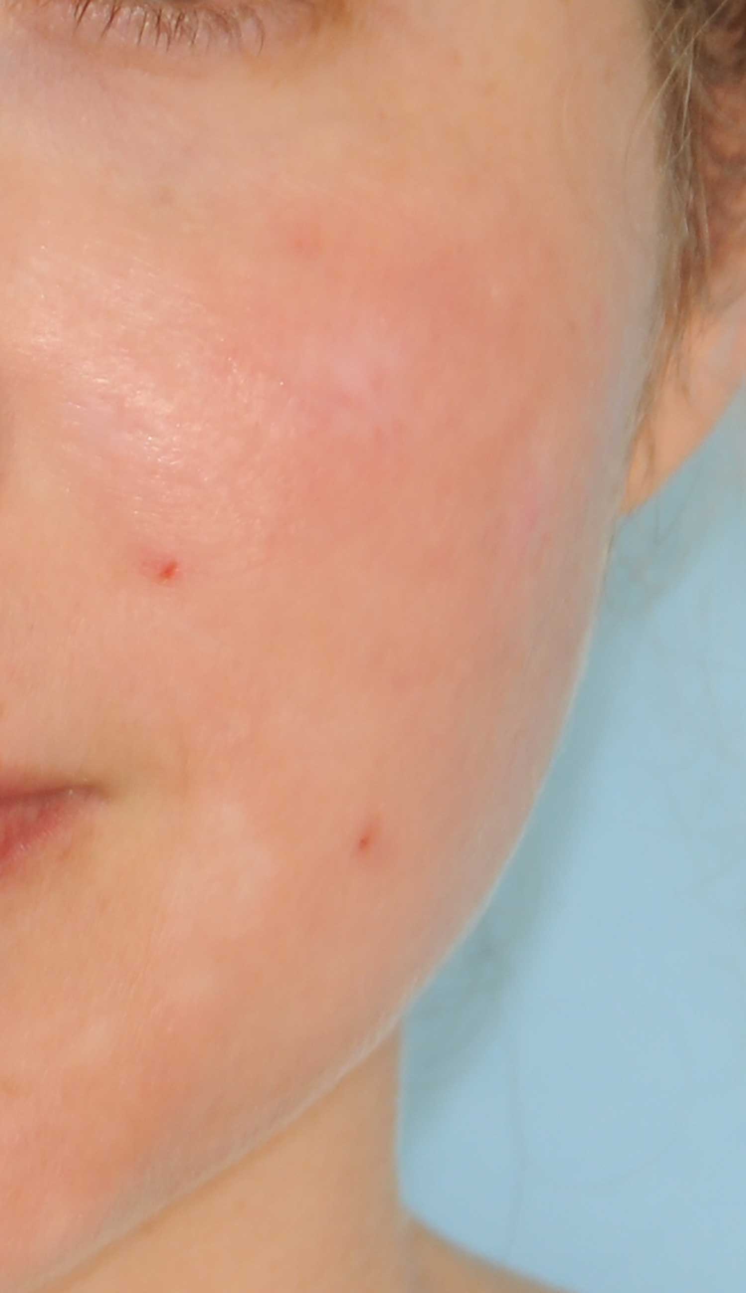 Acne Scar Treatment Before & After Photo