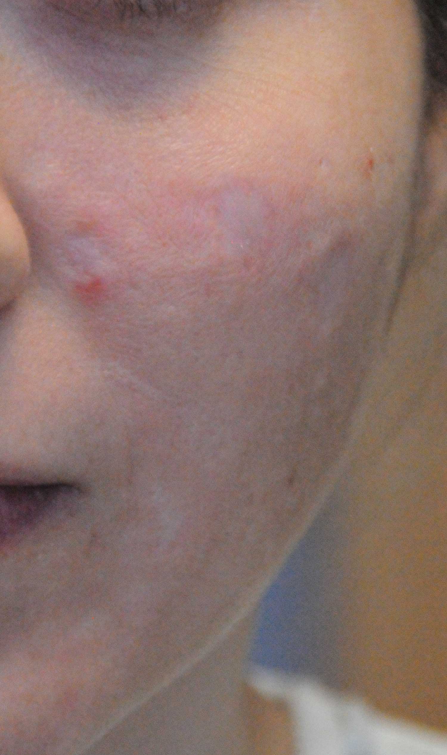 Acne Scar Treatment Before & After Photo