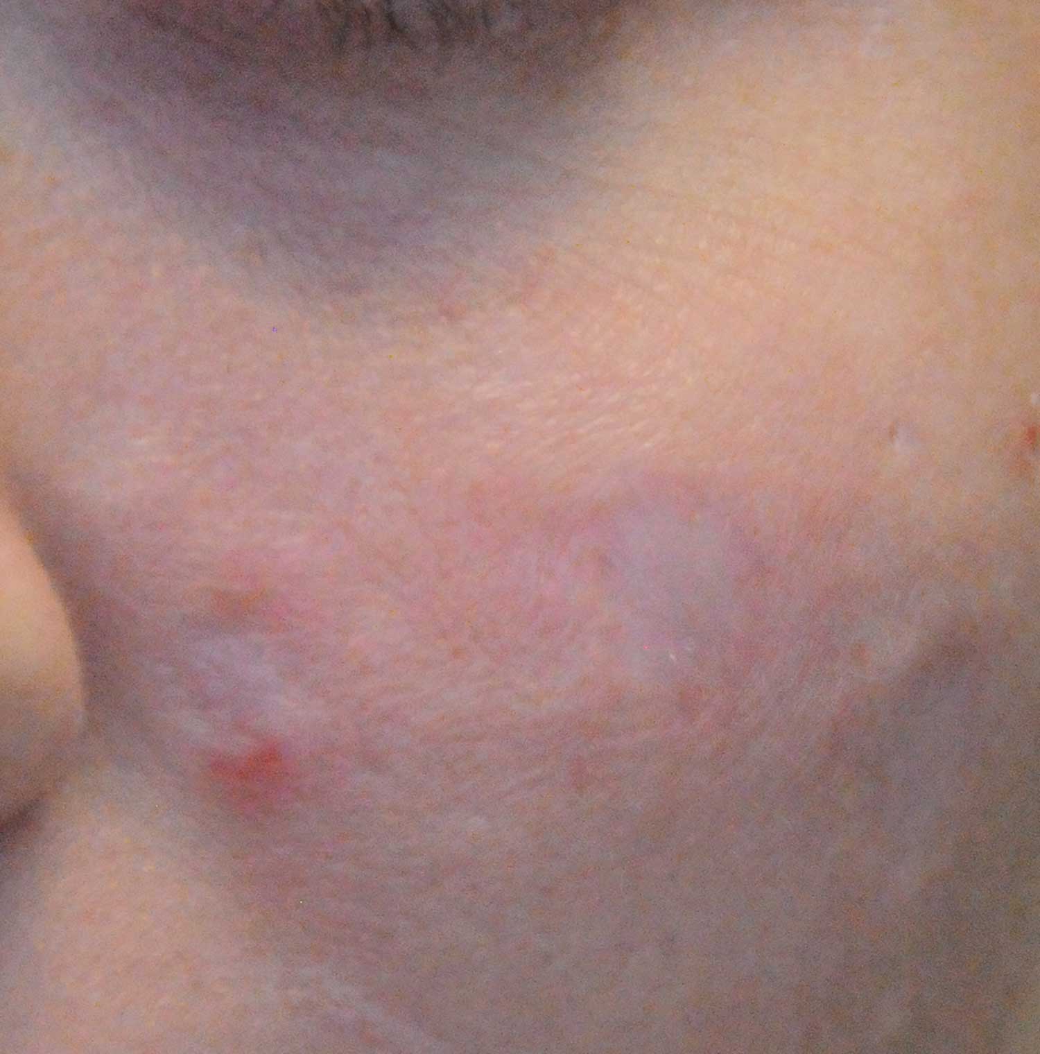 Acne Scar Treatment Before & After Photo