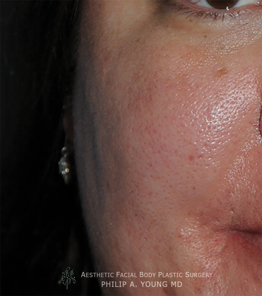 Acne Scar Treatment Before & After Photo