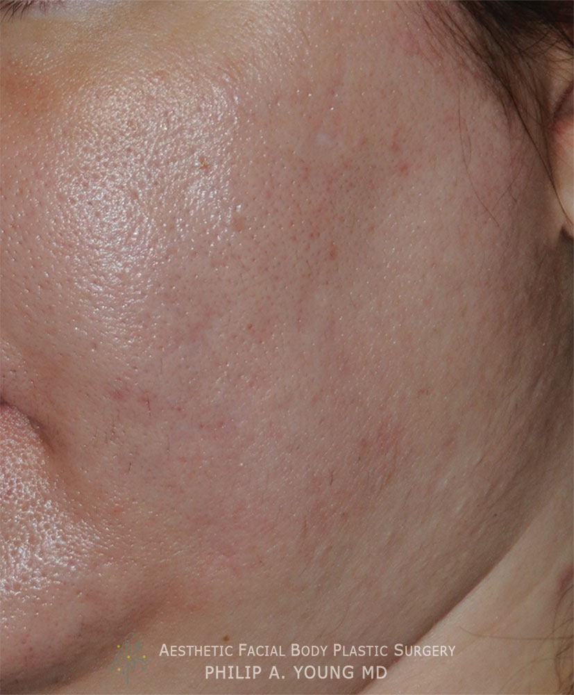 Acne Scar Treatment Before & After Photo