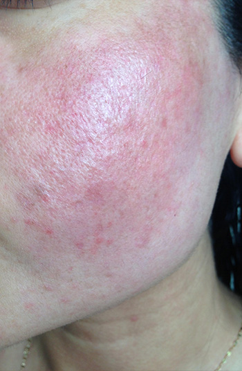 Acne Scar Treatment Before & After Photo