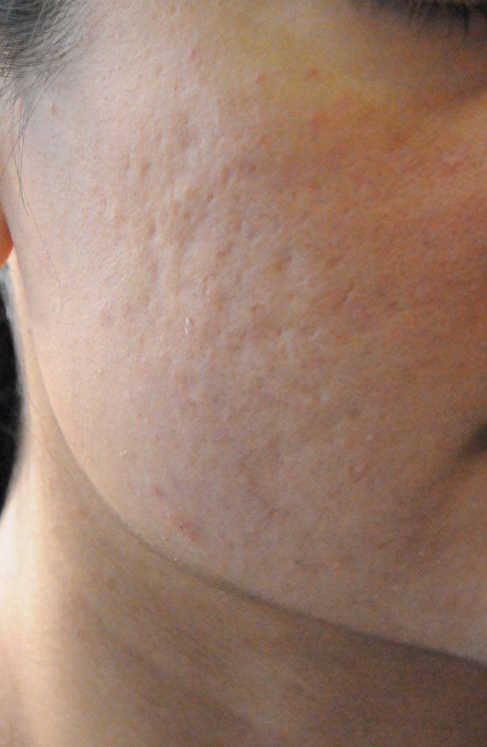 Acne Scar Treatment Before & After Photo