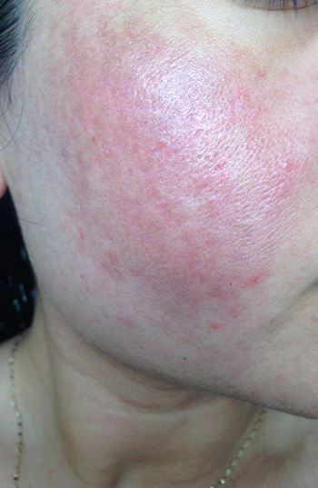 Acne Scar Treatment Before & After Photo