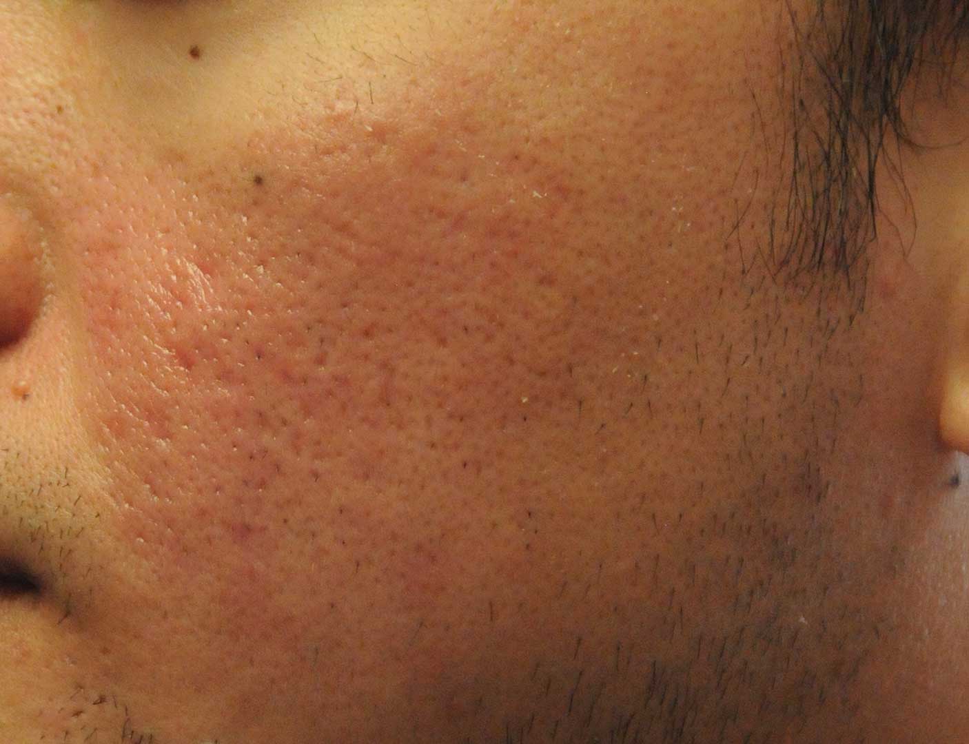 Acne Scar Treatment Before & After Photo