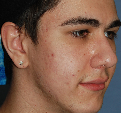 Acne Scar Treatment Before & After Photo