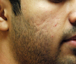 Acne Scar Treatment Before & After Photo