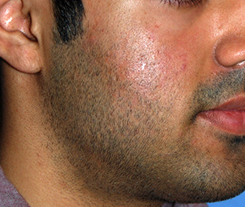 Acne Scar Treatment Before & After Photo