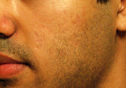 Acne Scar Treatment Before & After Photo