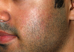 Acne Scar Treatment Before & After Photo