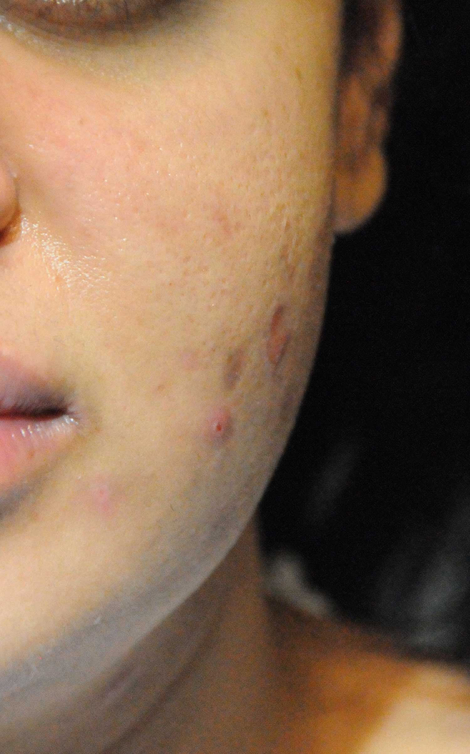 Acne Scar Treatment Before & After Photo