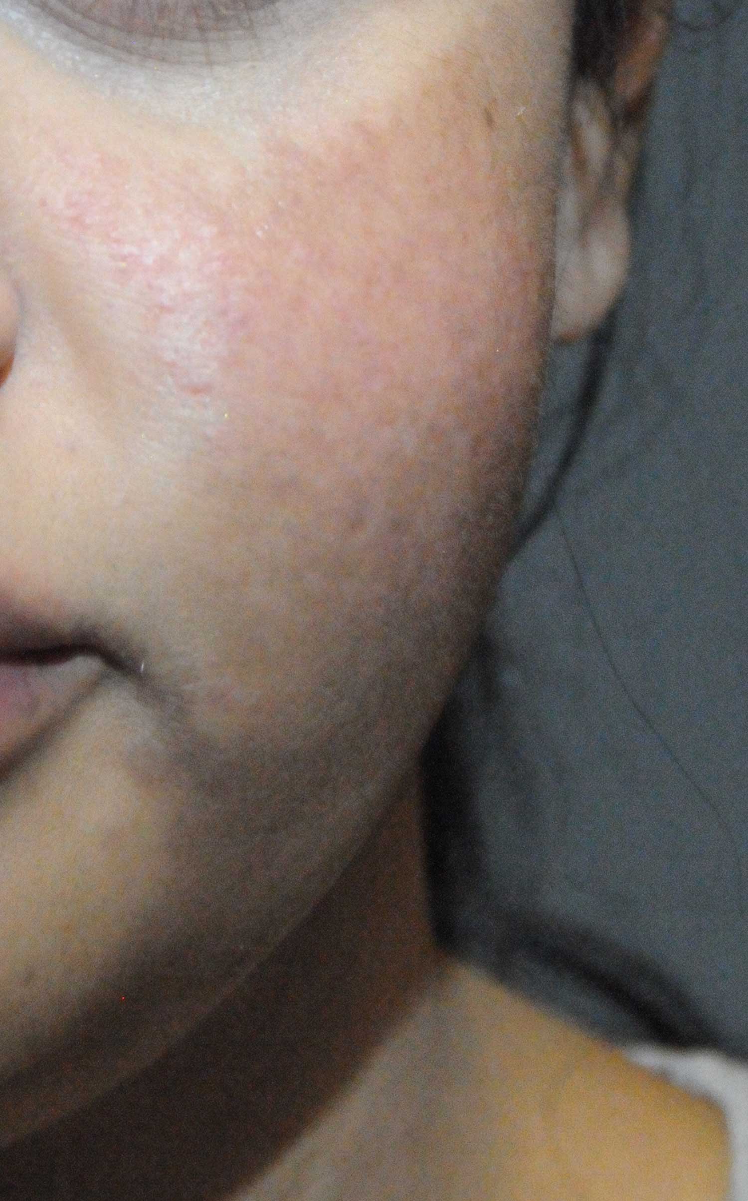 Acne Scar Treatment Before & After Photo