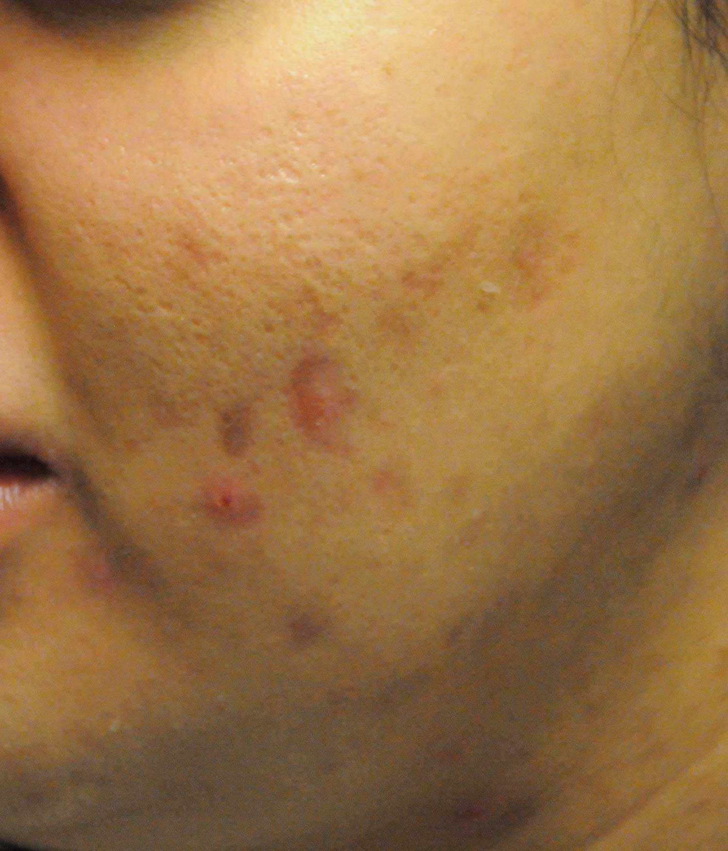 Acne Scar Treatment Before & After Photo