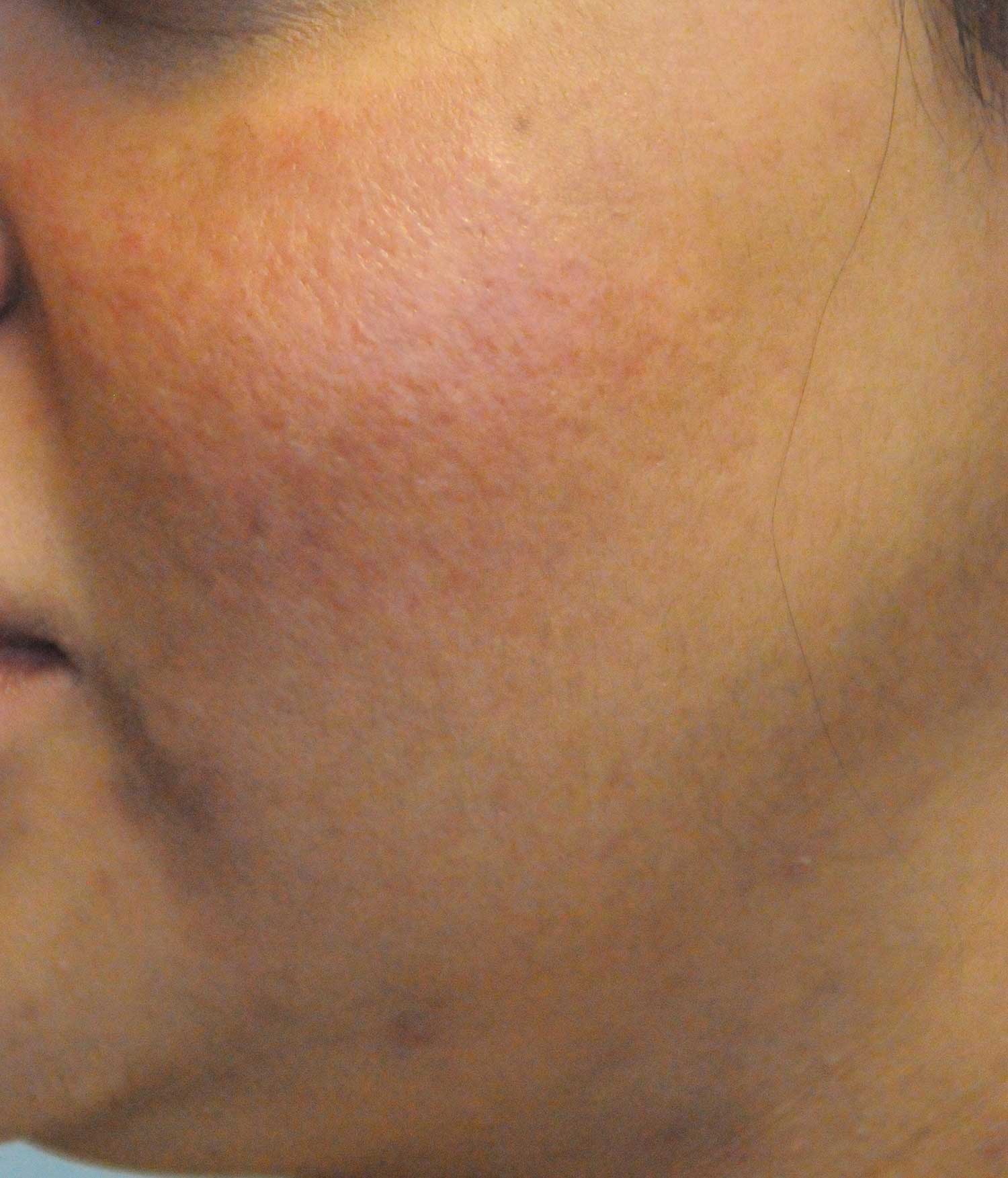 Acne Scar Treatment Before & After Photo