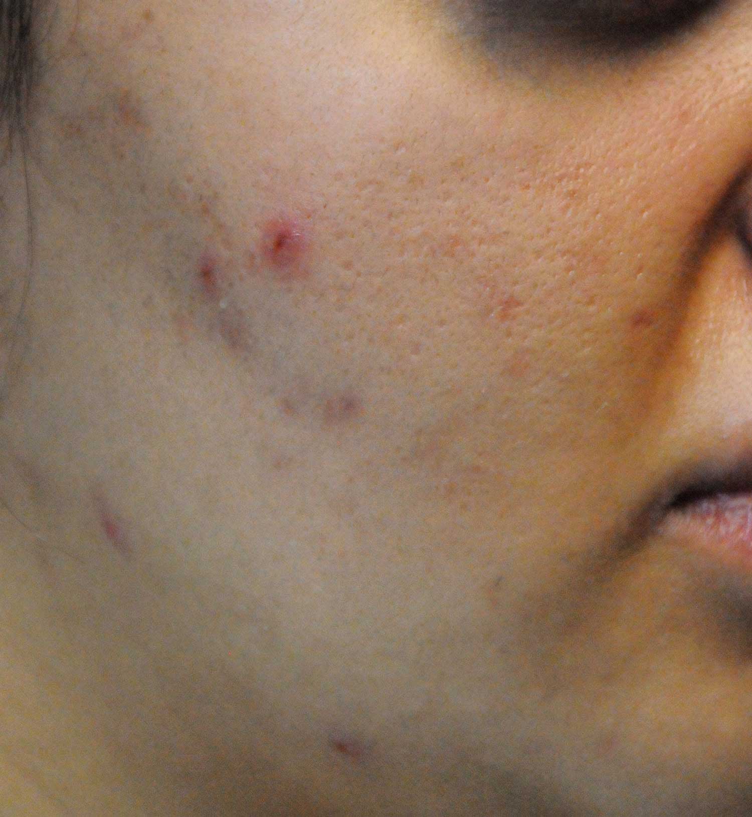 Acne Scar Treatment Before & After Photo