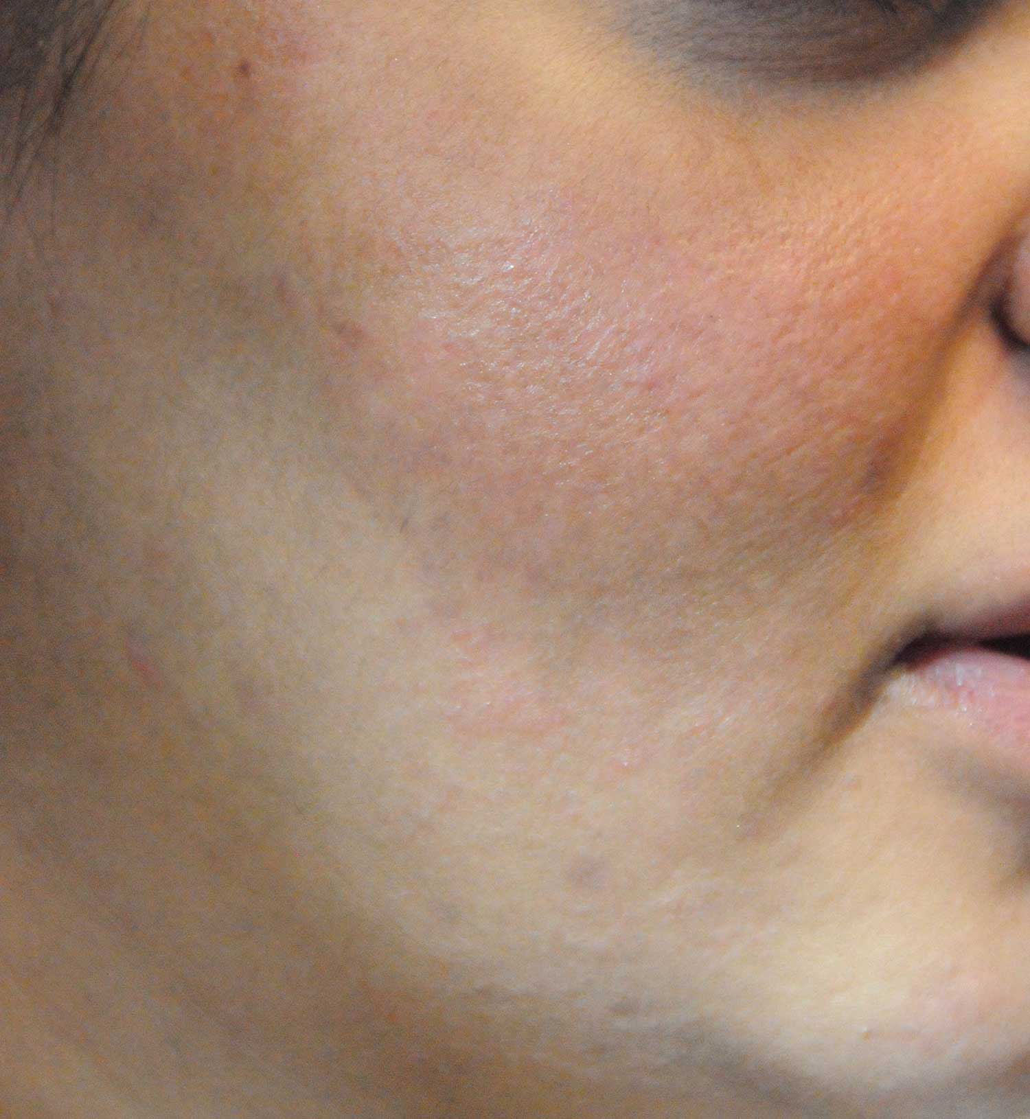 Acne Scar Treatment Before & After Photo