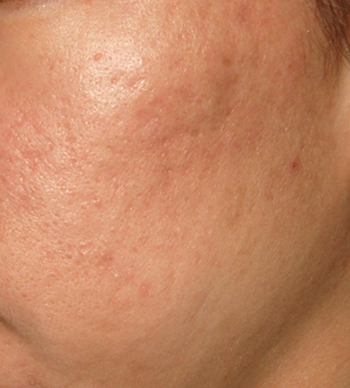 Acne Scar Treatment Before & After Photo