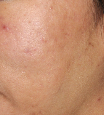 Acne Scar Treatment Before & After Photo