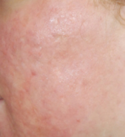 Acne Scar Treatment Before & After Photo