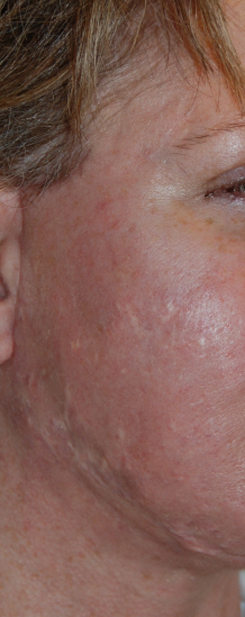 Acne Scar Treatment Before & After Photo