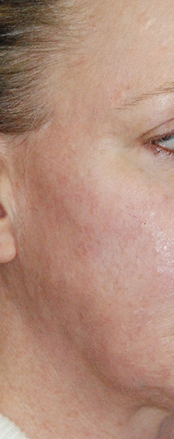 Acne Scar Treatment Before & After Photo