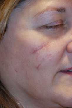 Acne Scar Treatment Before & After Photo