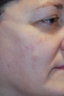 Acne Scar Treatment Before & After Photo