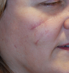 Acne Scar Treatment Before & After Photo