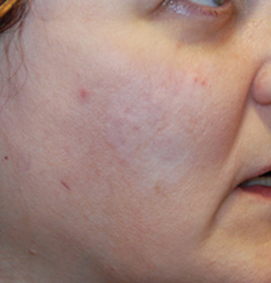 Acne Scar Treatment Before & After Photo